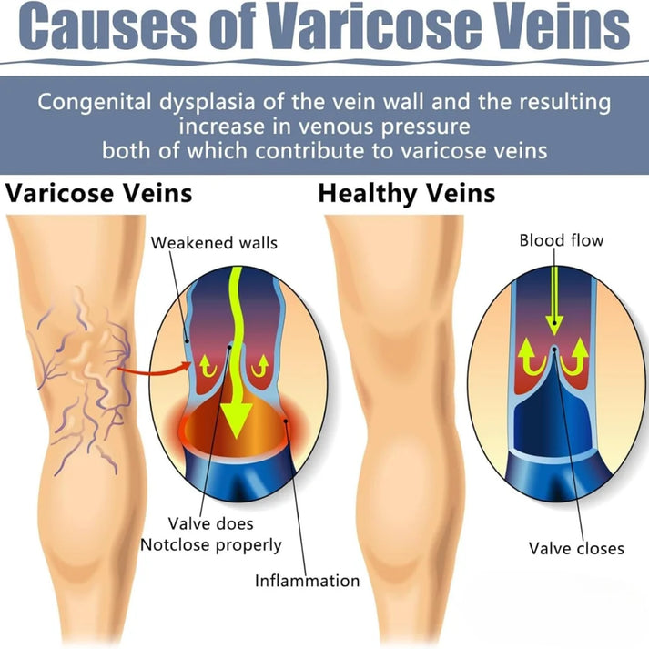 VariCose™ - Instant Relief Varicose Vein Patches (Pack of 20)