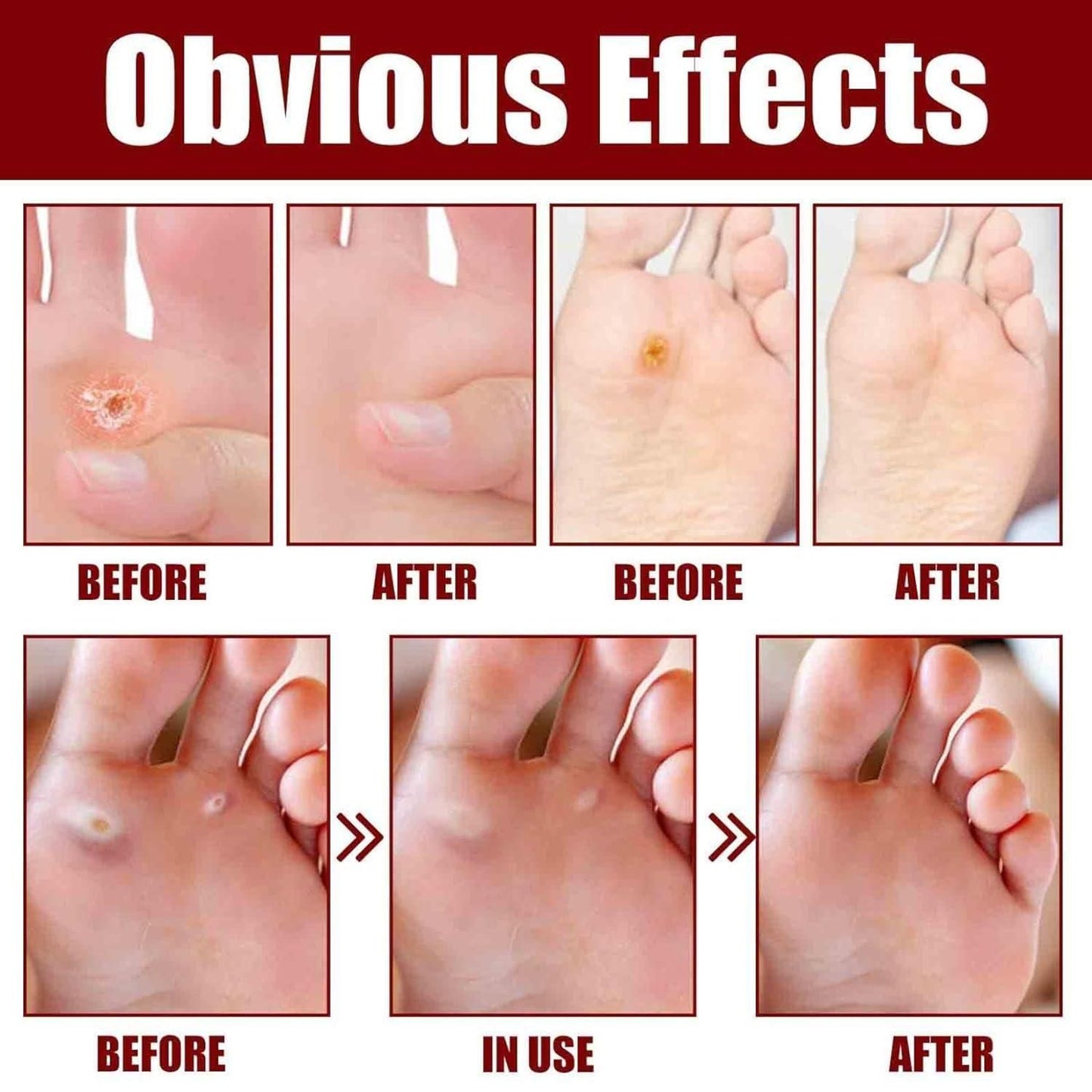 Ultimate Feet Corn Removal Serum - Dr. Recommended