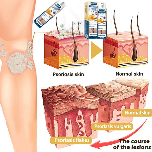 Premium PsoriaHeal Bee Venom Psoriasis Treatment Spray š£ Recommended by Experts š©āāļø
