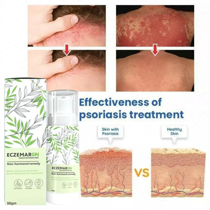 Eczemaron Anti Fungal Cream Spray | Buy 1 Get 1 Free
