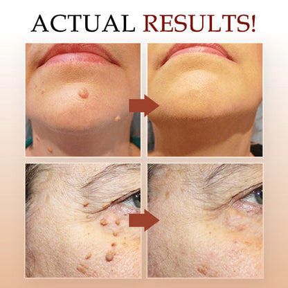 Derma Smooth Skin Tag Removal Patch🌟 (Buy 1 Get 1 Free 😍)