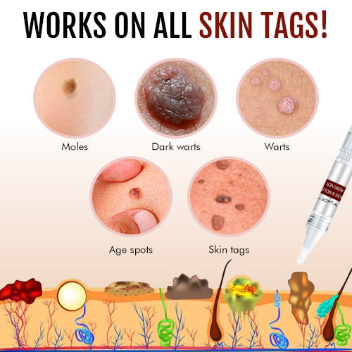 Derma Smooth Skin Tag Removal Patch🌟 (Buy 1 Get 1 Free 😍)