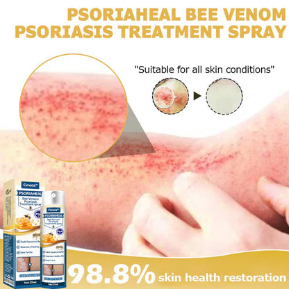 Premium PsoriaHeal Bee Venom Psoriasis Treatment Spray 📣 Recommended by Experts 👩‍⚕️