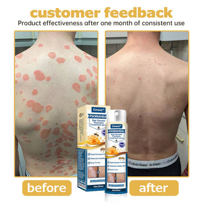 Premium PsoriaHeal Bee Venom Psoriasis Treatment Spray 📣 Recommended by Experts 👩‍⚕️